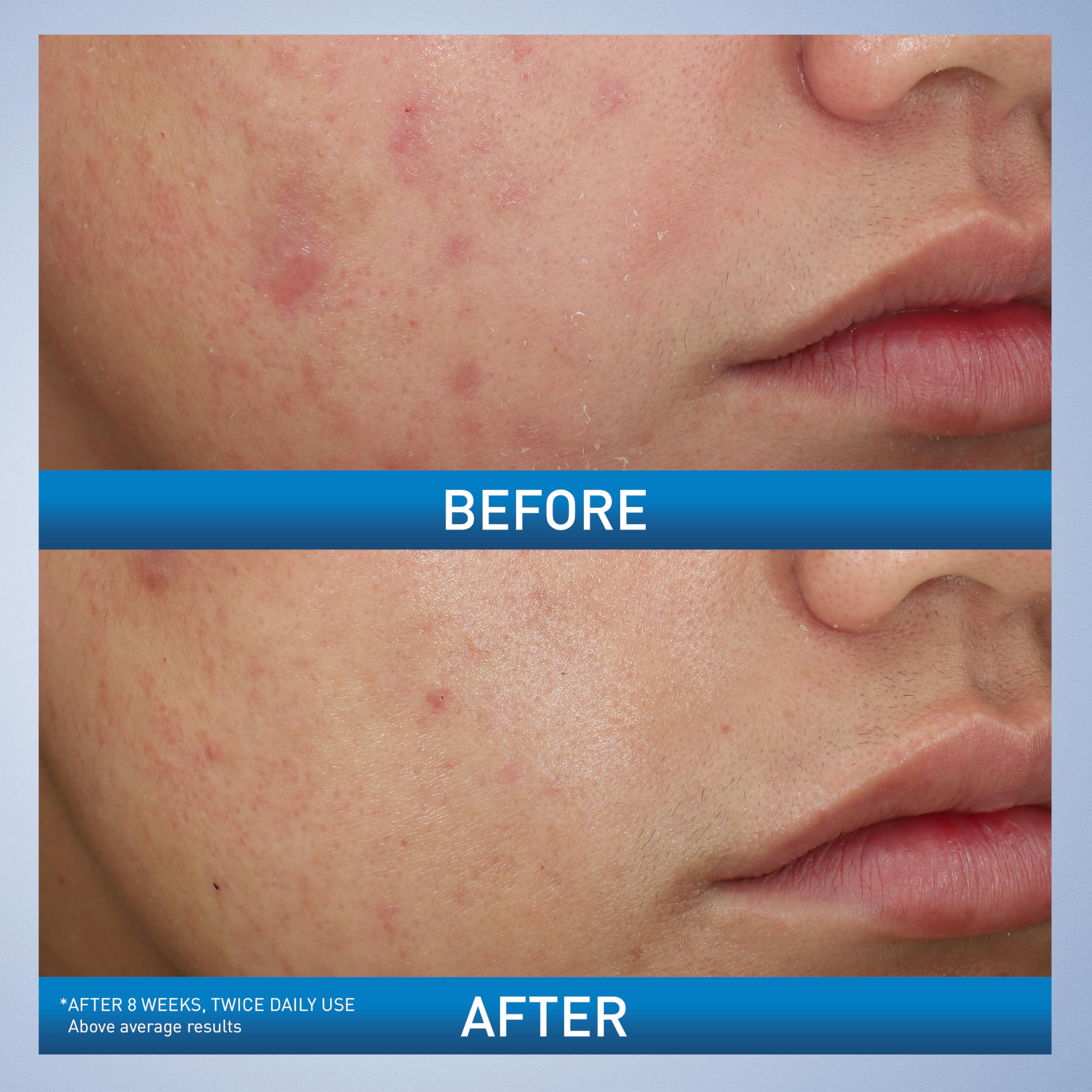 CeraVe Acne Foaming Cream Wash, Gentle Face and Body Cleanser with Benzoyl Peroxide 10%, Hyaluronic Acid, and Niacinamide, 10% Benzoyl Peroxide Treatment Clears Pimples and Blackheads 5 Oz - Image 3