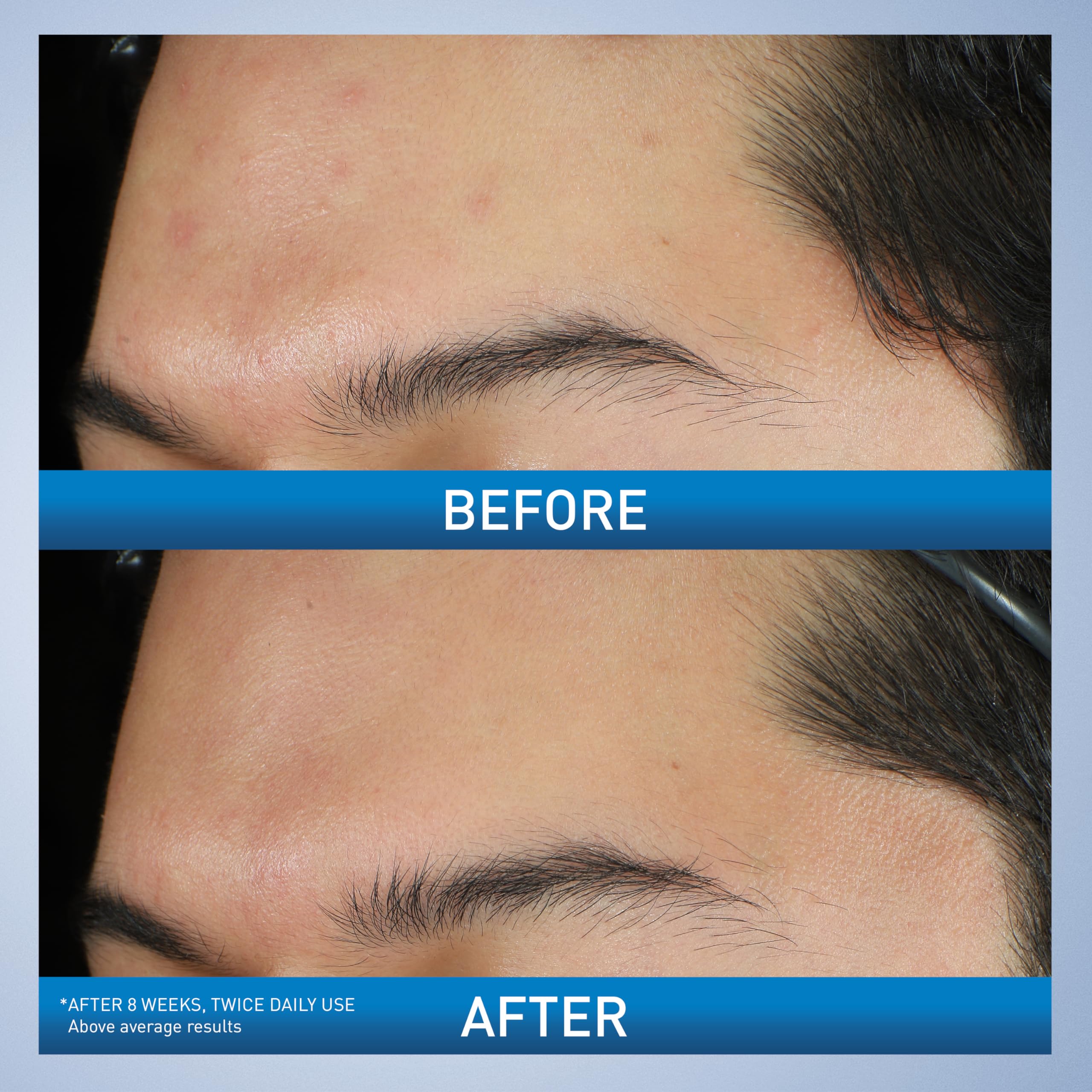 CeraVe Acne Foaming Cream Wash, Gentle Face and Body Cleanser with Benzoyl Peroxide 10%, Hyaluronic Acid, and Niacinamide, 10% Benzoyl Peroxide Treatment Clears Pimples and Blackheads 5 Oz - Image 4